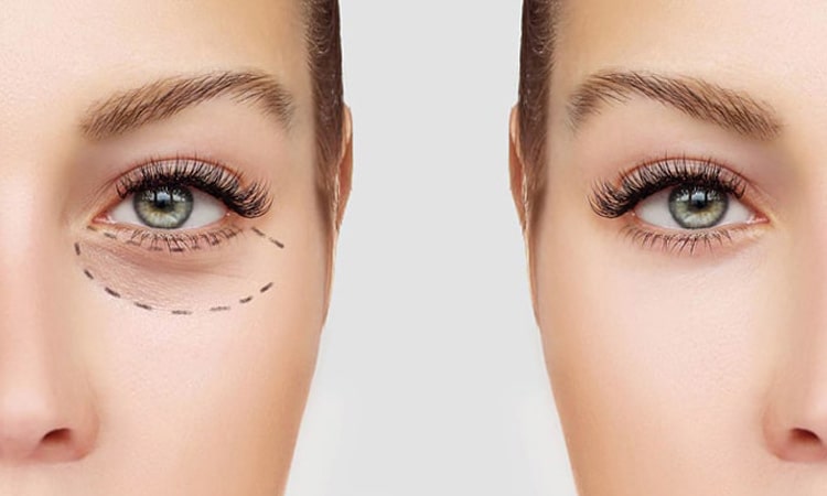 بهترین کرم دور چشم برای تیرگی